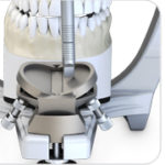 Mesa incisal ajustable