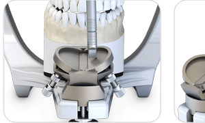 Mesa incisal ajustable