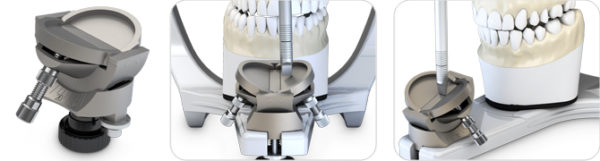 Mesa incisal ajustable